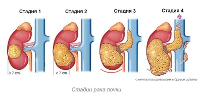 Всемирный день почки - ГБУЗ ЯНАО