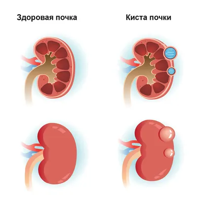 Камни в почках - симптомы и лечение - блог Медюнион