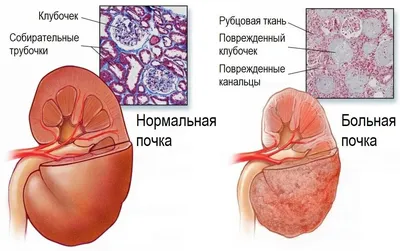 Ангиомиолипома почки – диагностика на УЗИ, КТ, хирургическое лечение в  Москве