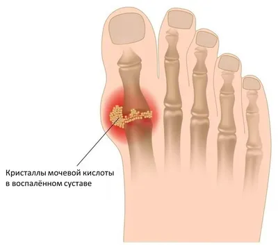 Причины подагры. Симптомы и лечение приступа подагрического артрита