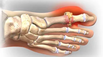 Подагра: что это и как лечить?