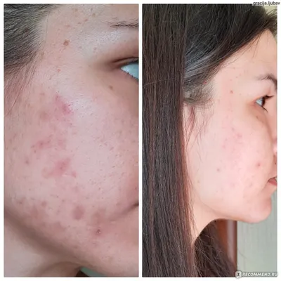 Подкожные прыщи | Skin cure, Skin health, Severe acne