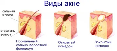 Лечение демодекоза