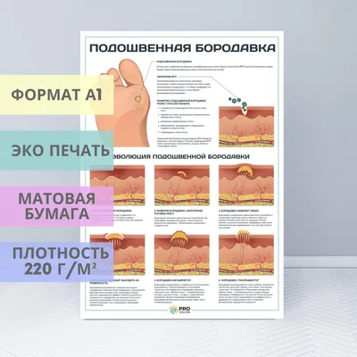 Как определить – бородавка или нет? ✓ Авторские статьи Клиники подологии  Полёт в Москве