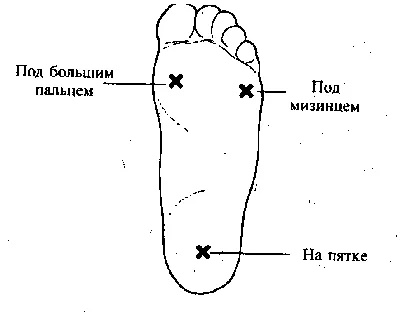 Лазерное удаление натоптышей, мозолей, подошвенных бородавок Харьков