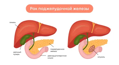 Как болит поджелудочная железа: симптомы и признаки панкреатита - Чемпионат