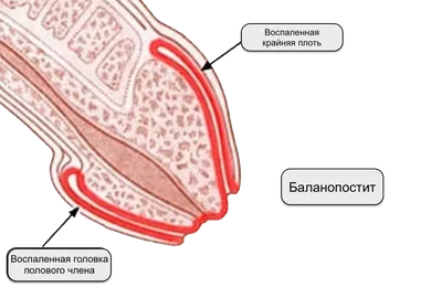 Баланопостит у детей | Со слов Детского Хирурга | Дзен