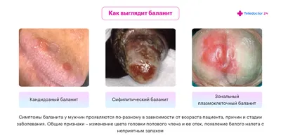 Баланит у мужчин: причины, диагностика, осложнения. Лечение баланита