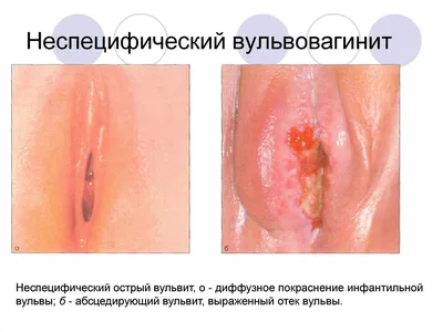 Вульвит: причины развития, симптомы и методы лечения