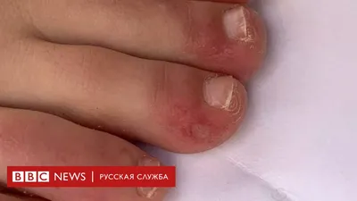 Сухость и краснота на пальцах ног у ребенка - Вопрос детскому дерматологу -  03 Онлайн