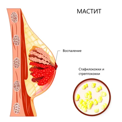 Мастит - что это такое, симптомы, лечение, профилактика