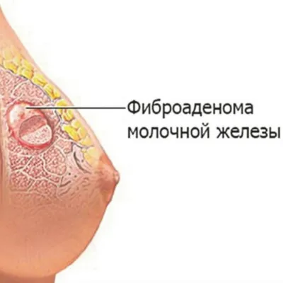 9 мифов о раке груди, которым не стоит верить - Горящая изба