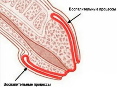 Лечение баланопостита у мужчин в Хабаровске - Медикъ