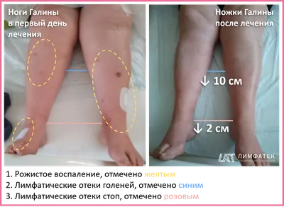 Воспаление надкостницы: как лечить и как не получить - \"Марафонец\"