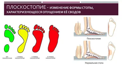 Бурсит – воспаление синовиальной сумки | Статьи клиники Ланцет