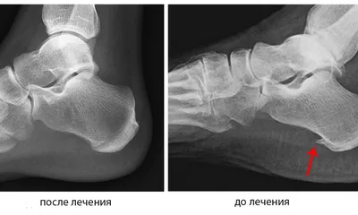 Боль мышц колена: причины, симптомы боли мышц выше и ниже колена, лечение в  Москве