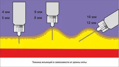 Терапевт Слободина: боль после уколов таит в себе опасность