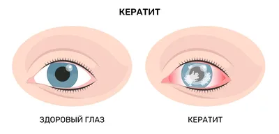 Покраснение глаз при конъюнктивите - энциклопедия Ochkov.net