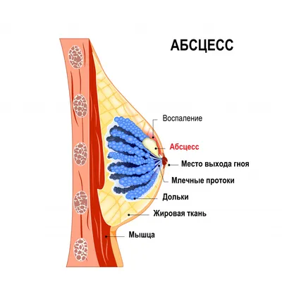 Заболевания молочных желез у женщин: виды, симптомы, диагностика и лечение