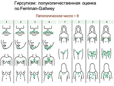 Синдром поликистозных яичников: причины, симптомы и лечение. Беременность  при СПКЯ?