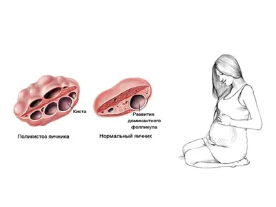 Поликистоз яичников, причины, симптомы, диагностика, лечение