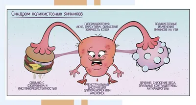 Поликистоз яичников фото