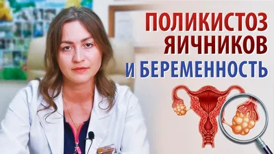 Синдром поликистозных яичников