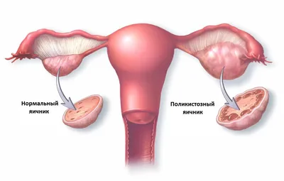 Поликистоз яичников - диагностика и лечение - симптомы, причины, методы  лечения в МЦ \"Звезда\"