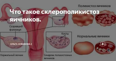 Медицинский центр «Хадасса» Hadassah Medical Center - Влияние синдрома поликистозных  яичников на жизнь женщины Сбой менструального цикла, лишний вес и проблемы  с кожей - симптомы, с которыми сталкивалась практически каждая женщина.  Часто