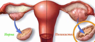 Поликистоз яичников: причины, симптомы, лечение | Балтмед