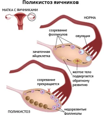 Как забеременеть при поликистозе яичников?