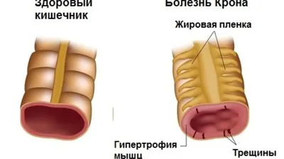 Полипы в кишечнике и желудке. Биопсия полипа желудка.