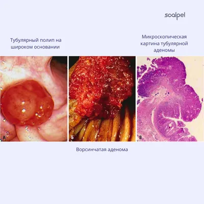 полипы толстой кишки (полип анального канала, полип прямой кишки) - YouTube