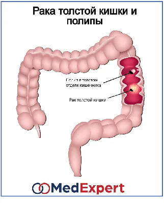 Полипы толстой кишки | Scalpel Med | Дзен
