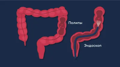 Полипы в кишечнике и желудке. Биопсия полипа желудка.