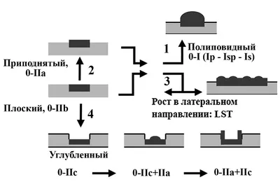 Воспаление толстой кишки Векторное изображение ©Pikovit 490447148