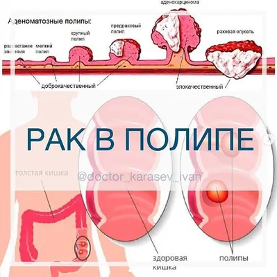 Полипы толстого кишечника, диагностика и лечение «В надежных руках»