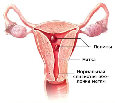 Доброкачественные новообразования прямой кишки и анального канала