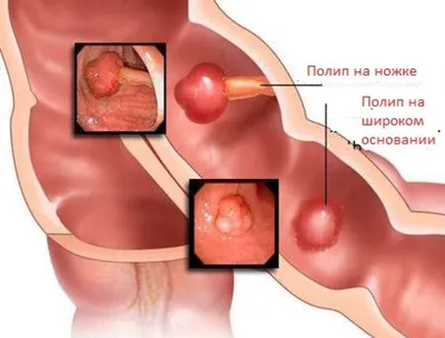 Полипы толстого кишечника | Промедклиник