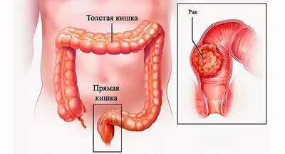 Ретроспективный анализ предраковых заболеваний толстой и прямой кишки –  тема научной статьи по клинической медицине читайте бесплатно текст  научно-исследовательской работы в электронной библиотеке КиберЛенинка