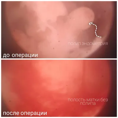 ᐈ Полипы в носу ~【Симптомы, причины, лечение в Киеве】