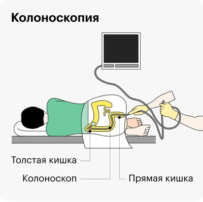 Ещё не конец. Онколог рассказал, почему полипы возвращаются в организм даже  после удаления — Секрет фирмы