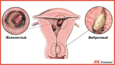 Лечение полипов в эндометрии и шейке матки в Москве цена в Клинике АВС