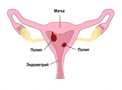 Полипы толстой кишки: причины, симптомы, диагностика и лечение болезни