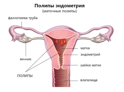Полип уретры: симптомы, причины, диагностика и лечение у женщин и мужчин в  клинике «АльтраВита»