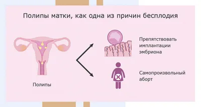 Полипозный риносинусит (полипы полости носа) - диагностика и лечение в  Москве. Консультация врача.