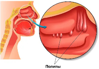 Полипы в носу - Что это такое? Симптомы, причины, диагности, лечение