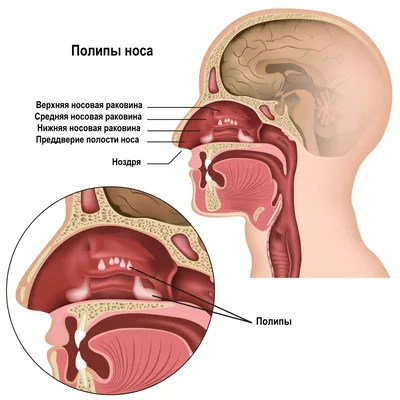 Лечение (удаление) полипов в носу в Москве - симптомы и причины