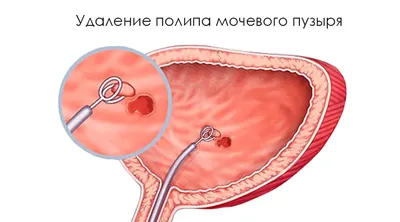 Полипы носа и околоносовых пазух. Операция удаления полипов в носу.