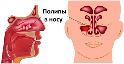 Полипотомия носа: лечение полипов носа в Николаеве